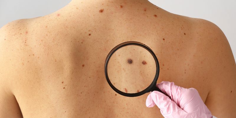 Cuộc sống hiện đại có gì mới với nốt ruồi?